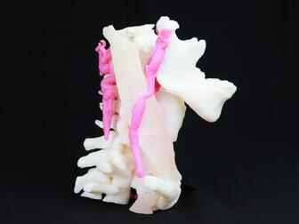 Impresión 3D del Schwannoma mandibular