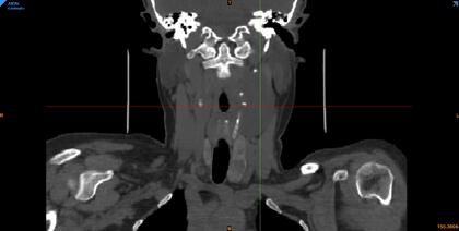 Plano coronal del Schwannoma Mandibular