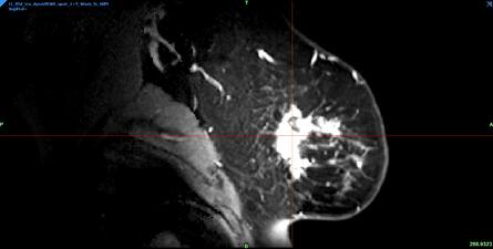 Plano sagital de tumor mamario