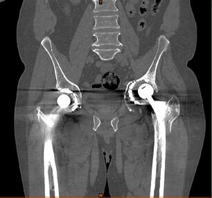 Tomografía computarizada de fractura acetabular y de fémur