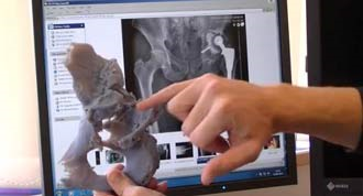 Cadera impresa en 3D