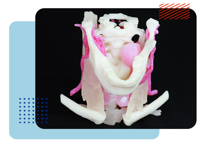 Modelo de Schwannoma mandibular impreso en 3D.