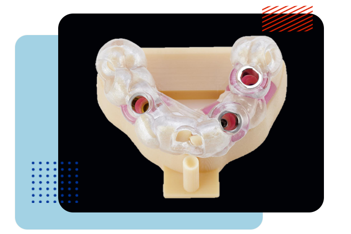 Implantología dental en impresión 3D