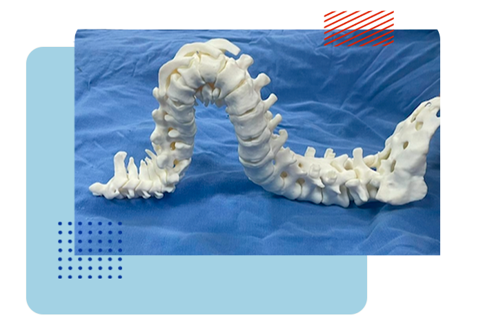 Cirugía de columna inoperable es posible gracias a tecnología 3D